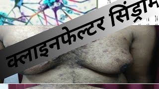 klinefelter syndrome  klinefelter syndrome in hindi class 12 biology  क्लाइनफेल्टर सिंड्रोम [upl. by Vivi]