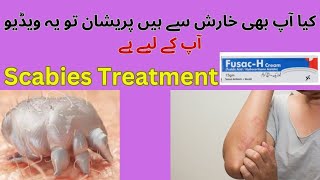 Ab apki purani sa purani kharish b ho ge khatam  Scabies treatment  Scabies home treatment [upl. by Lem595]