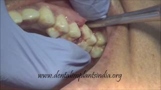 How to use luxator and forceps to remove upper decayed first molar [upl. by Legir660]