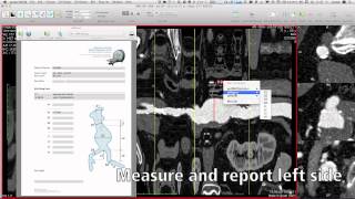 AAA Sizing with aycan OsiriX PRO [upl. by Hallie541]