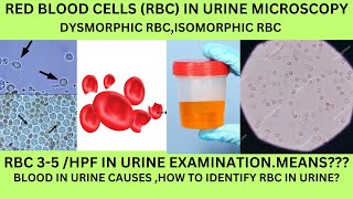 RBC IN URINE MICROSCOPYCAUSES OF RBC IN THE URINE DYSMORPHIC RBC ISOMORPHIC RBCGHOSTRBC IN URINE [upl. by Simmonds471]