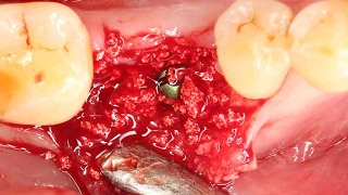 Clinical application of OSTEON™ lll Dentium alloplastic graft [upl. by Savage]