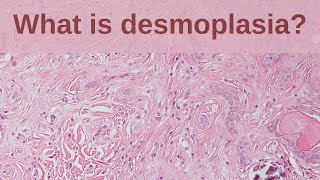 What is Desmoplasia  Pathology mini tutorial [upl. by Dragone998]