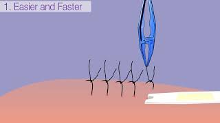 Introducing the SutureOut™ Suture Removal Tool [upl. by Nara576]