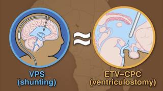 Treatment for Postinfectious Hydrocephalus in Infants [upl. by Gregory]