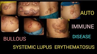 bullous systemic lupus erythametoususayurved [upl. by Aitnyc47]