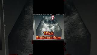 Hemorrhagic Cyst  Ovarian cyst  internal Echoes Haemorrhagic on Ultrasound [upl. by Lillith]