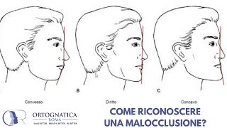 Come riconoscere una malocclusione dentoscheletrica [upl. by Nosnehpets656]