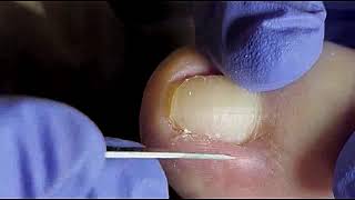 DIY Ingrown Toenail Removal  How to Safely Cut Ingrown Toenails at Home [upl. by Dalpe]