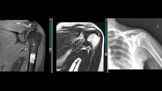 Enchondroma of humerus [upl. by Fabrianne]