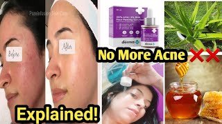 Secrets Revealed Acne Reduce ExplainedHow To Reduce pimple Causes  Prevention [upl. by Bently]