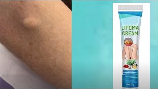 do lipoma removal creams work [upl. by Ykciv]