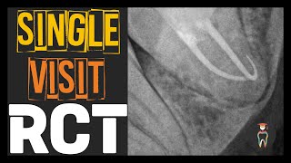 Single Visit Root Canal Treatment [upl. by Eitsrik]