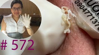 Acne Treatment Huong Da Nang572  2023 [upl. by Alliuqaj506]