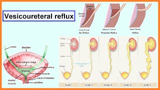 vesicoureteral reflux [upl. by Oad]