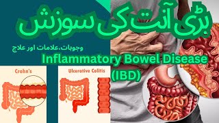 Inflammatory Bowl DiseaseIBD symptomscauses amp treatment  Crohns disease AmberhealthVlogs [upl. by Solracsiul]