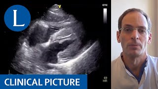 Myocarditis in a patient with COVID19 [upl. by Satsoc]