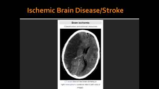 Ischemic Brain DiseaseStroke [upl. by Ycnaf328]