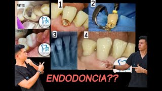 QUE ES UNA ENDODONCIA Y COMO SE HACE [upl. by Balac]