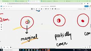 ANTEPARTUM HAEMORRHAGE DISCUSSION [upl. by Zipah]