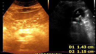 Cholelithiasis  Cholesterol polyp Moderate diffuse fatty Liver  Renal cortical cyst [upl. by Siraf109]