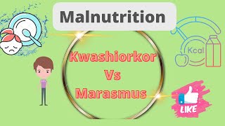 Kwashiorkor vs Marasmus DefinationDifference Malnutrition Nursing notes [upl. by Norok]