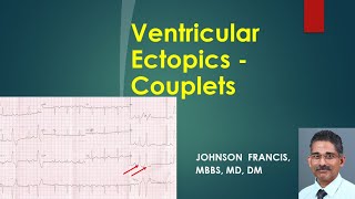 Ventricular Ectopics  Couplets [upl. by Haiacim]