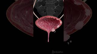 🩺 Understanding the Stages of Bladder Cancer 🩺 [upl. by Niran]