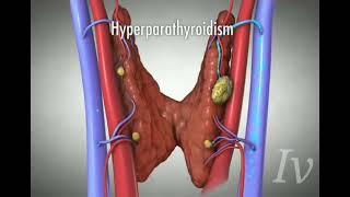 Hyperparathyroid PTH [upl. by Demmy]