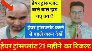 21 month hair transplant result hair transplant result 2024hairtransplantcostinindia [upl. by Akemrehs]