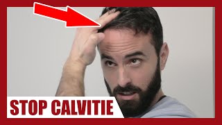 CALVITIE  Comment appliquer correctement le MINOXIDIL afin de la stopper [upl. by Minsk]