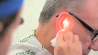 Ear Irrigation with a Propulse NG Ear Irrigatorwmv [upl. by Mairim]