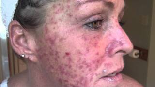 Skin Cancer My VlogJournal Treatment W EFUDEX vid9 [upl. by Ahsiner]