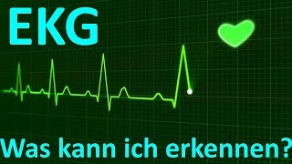 Was erkennt man beim EKG Monitoring 3Kanal [upl. by Rebak]