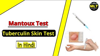 Tuberculin Skin Test  Mantoux test  Procedure amp Principle [upl. by Reniar516]