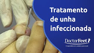 TRATAMENTO DE UNHA INFECCIONADA [upl. by Kowatch]