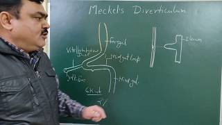 Meckels diverticulum by Dr A K Singh [upl. by Ileyan]