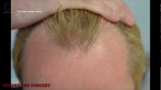 FUE 2207 Ufs MeDiKemos Hair Transplantation ENG [upl. by Kemppe70]