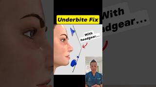 Fixing an Underbite with Headgear Heres How It Works dentallan dentist shorts [upl. by Annabella594]