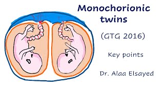 Monochorionic twins  GTG 2016 Key points [upl. by Cynara996]