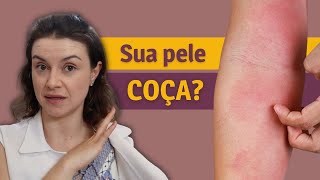 5 dicas de como cuidar de uma pele com DERMATITE ATÓPICA [upl. by Enerod]