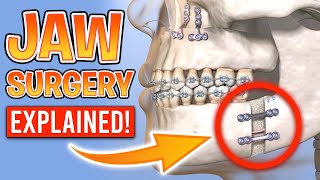 What is Orthognathic Surgery Jaw Surgery with Braces Explained [upl. by Judye]