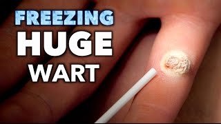 Freezing a HUGE INFECTED WART with liquid nitrogen  Dr Paul [upl. by Lehcir]