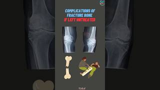 Complications of a fracture bone if left untreated orthopaedicseducation [upl. by Eletnahc]