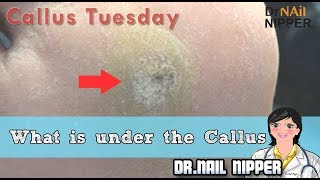 What is under the Callus Callus Tuesday 30 [upl. by Boorer61]