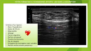 Les 10 critères échographiques dun lipome [upl. by Norita]