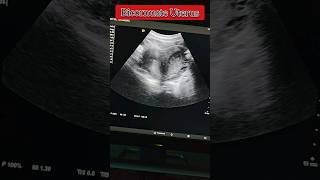 Bicornuate Uterus Heart Shaped medical radiology ultrasound uterus shorts viral [upl. by Skill]