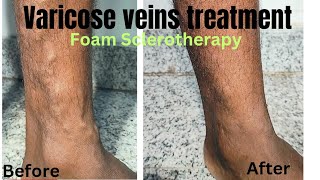 Foam sclerotherapy treatment for varicose veins Miracle of varicose veins treatment varicosevein [upl. by Nnednarb131]