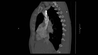 Normal CT Thorax [upl. by Farrington]