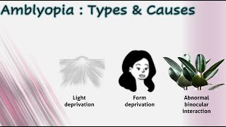 Amblyopia 1│ Types amp causes [upl. by Dori]